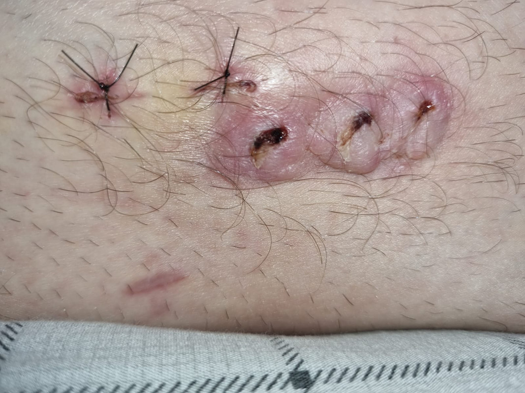 SIDE-LEG-STITCHES