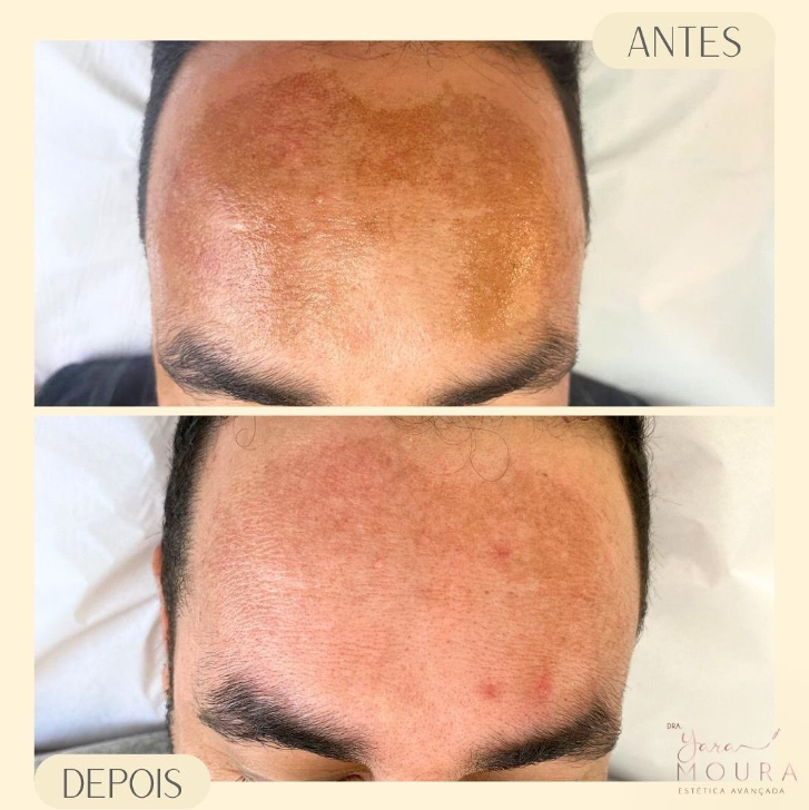 Resultado tratamento de manchas