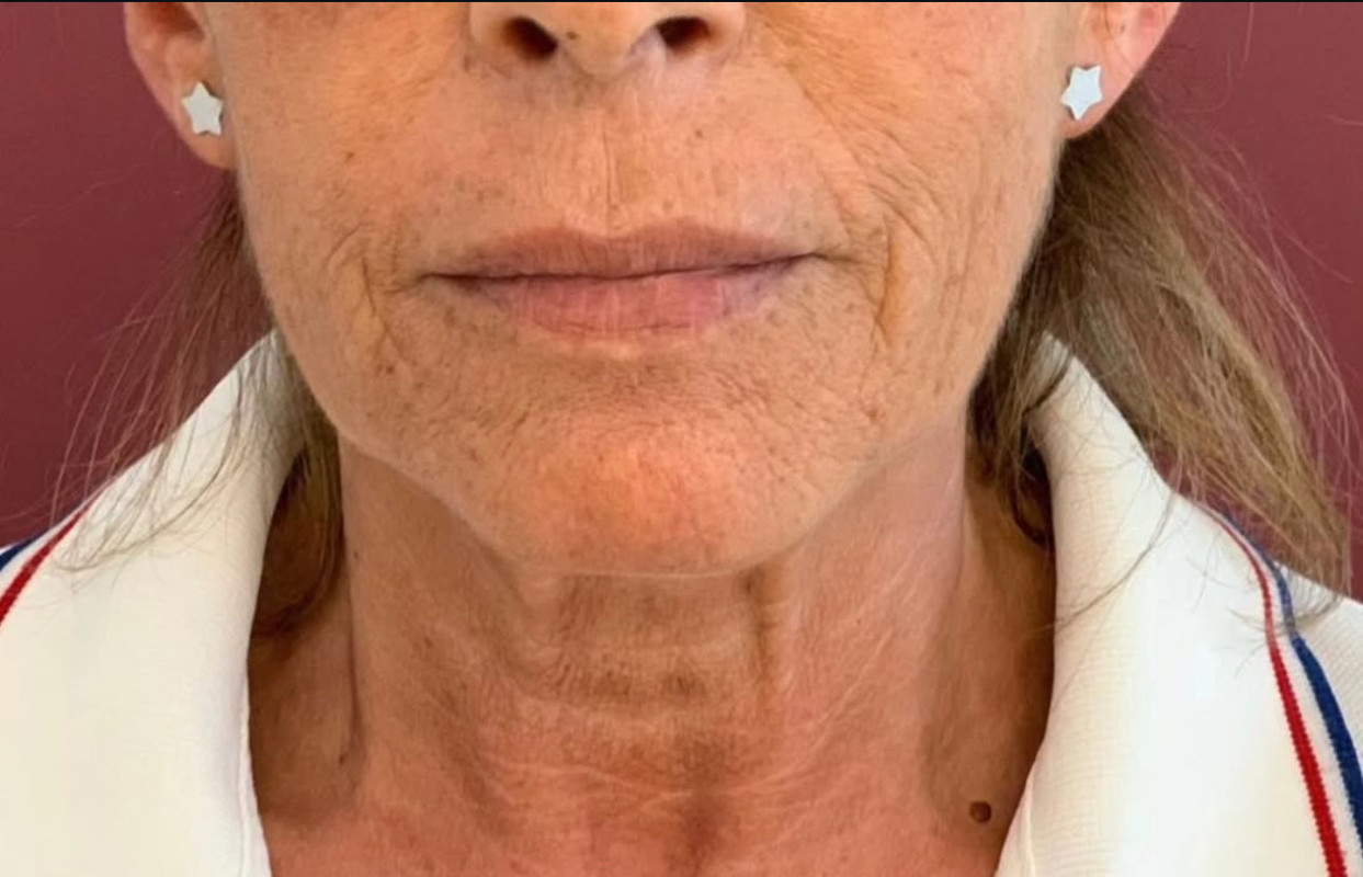 Teint terne et manque d'éclat - Transformation soin Jouvence