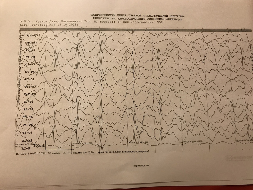Ээг отзывы детям. Нормальная диаграмма ЭЭГ. Результаты ЭЭГ. ЭЭГ при коматозных состояниях. ЭЭГ при различных заболеваниях.