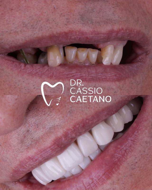 Resultado Implante 01