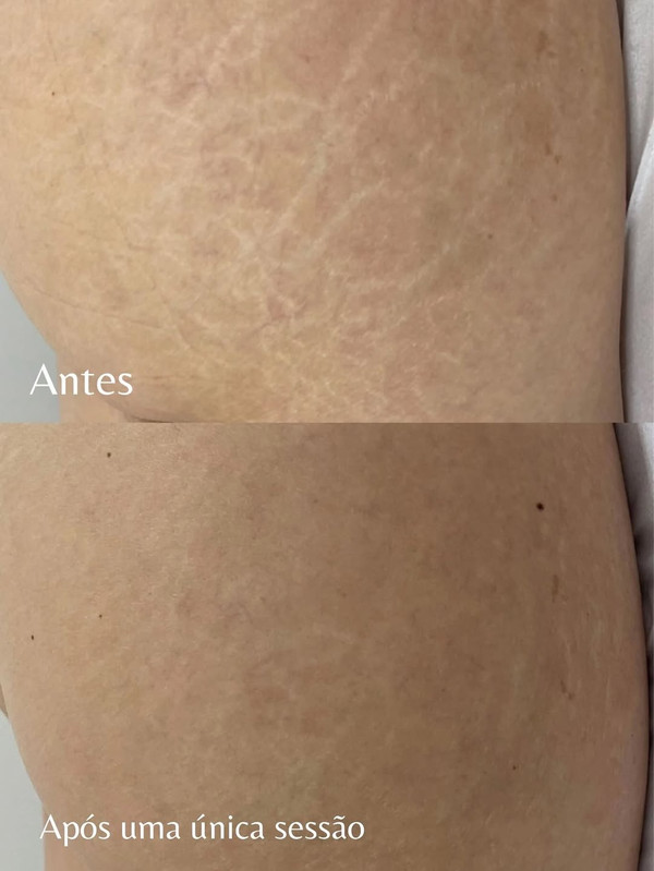 Tratamento para Estrias e Cicatrizes