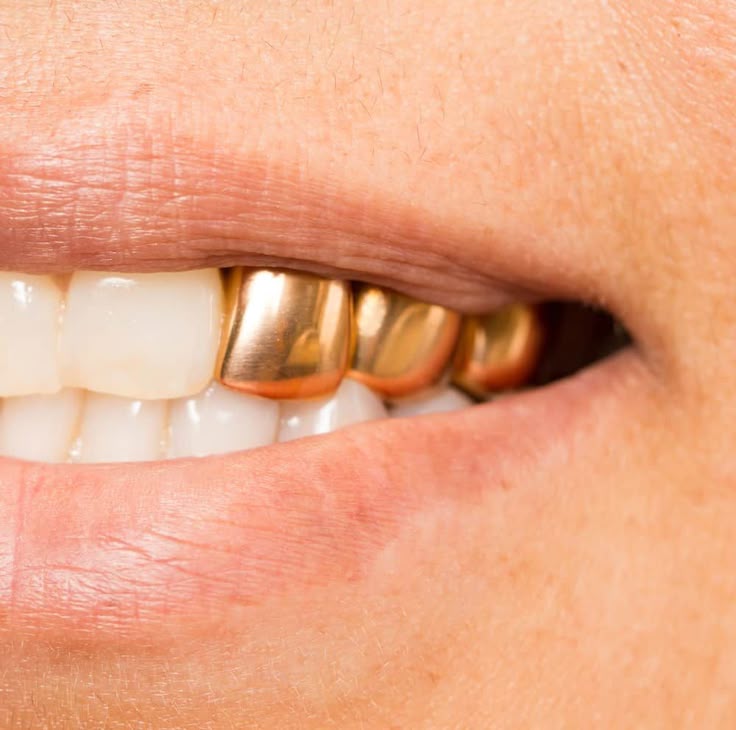 Gold vs Ceramic Crowns: An Economic Comparison of How Much Does a Gold Dental Crown Cost