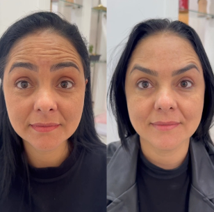 Resultado toxina botulínica