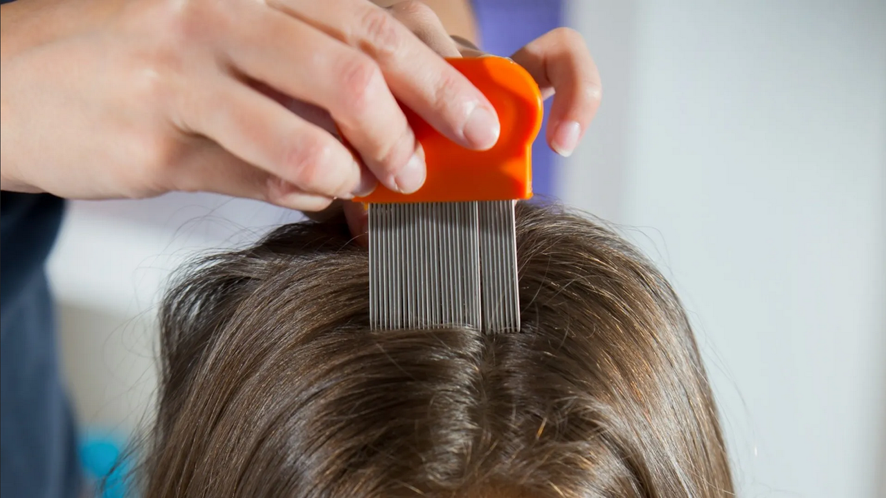 ¿Cómo quitar los piojos y liendres del cabello rápido?