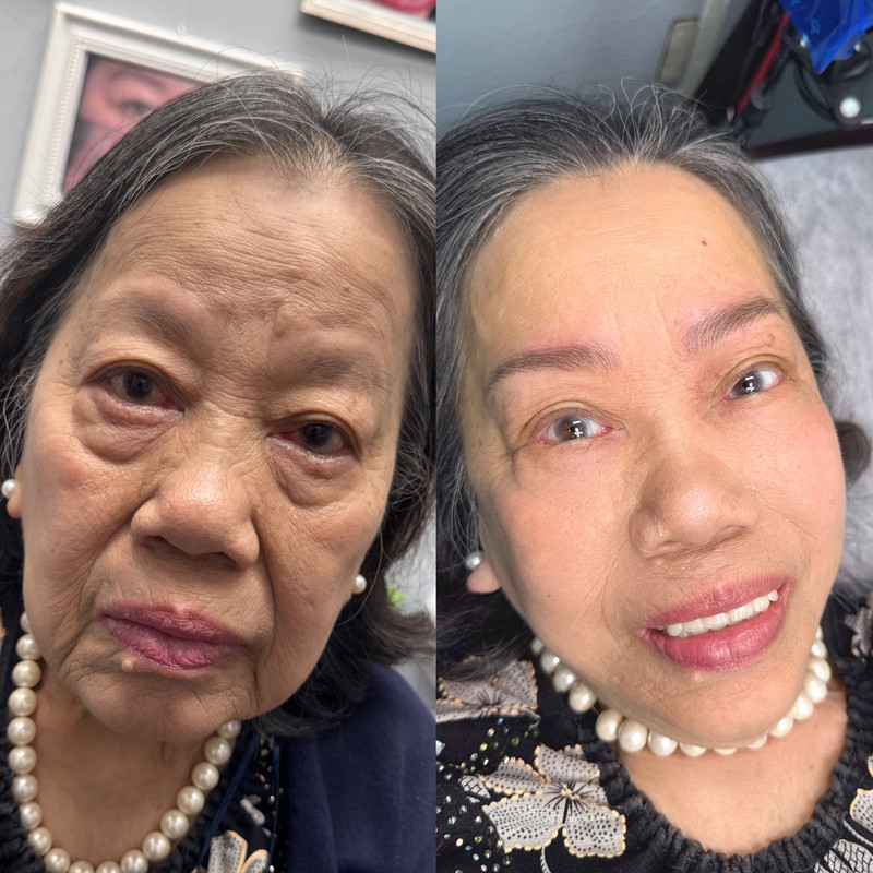 Eyebrow Enhancement Example New 1