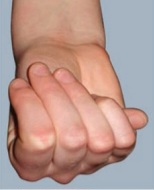 Positive thumb sign (Steinberg sign) – thumb protrudes beyond ulnar border in clenched fist