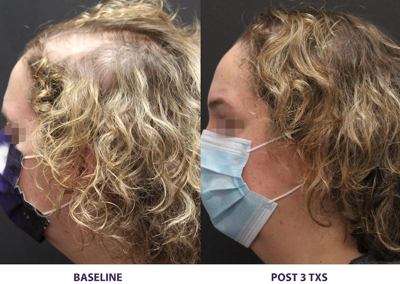 Alma TED hair restoration at Let's Face It Med Spa in Denver.