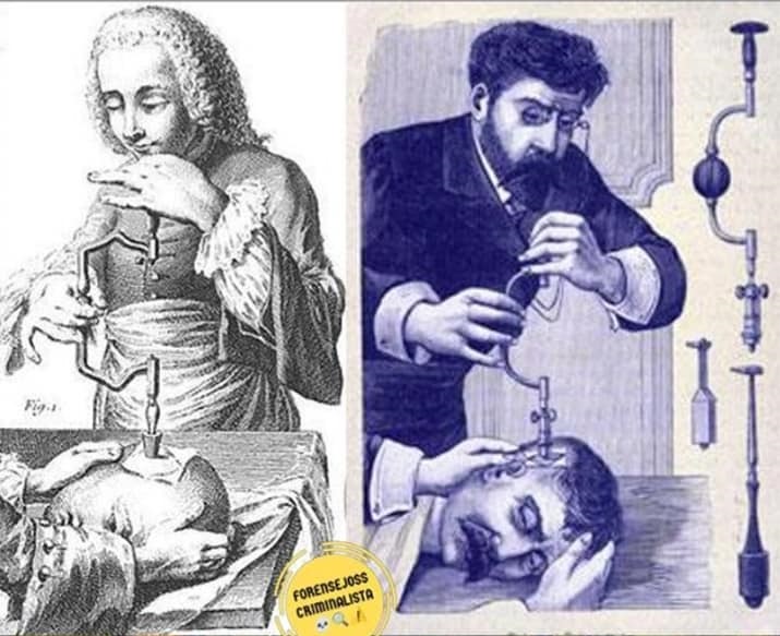 fotocraneotomia1