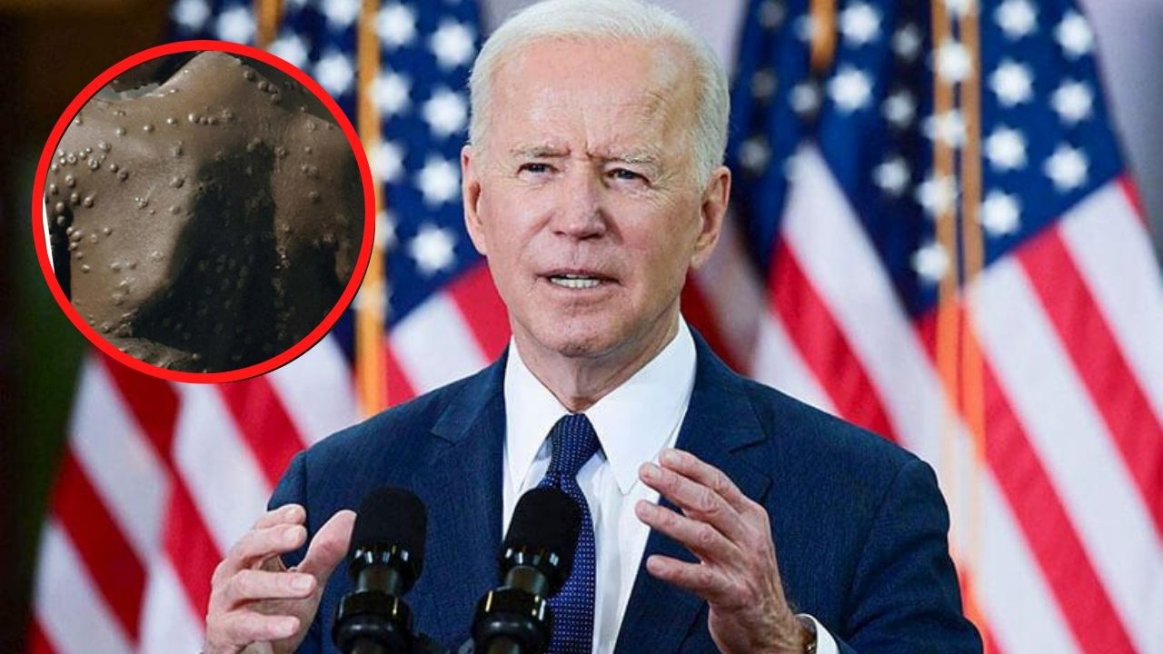 Joe Biden crea equipo para responder ante la Viruela de Mono