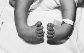 Bilateral clubfoot - both feet in equinus, varus, adduction, cavus deformity