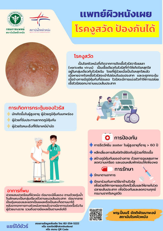 แพทย์ผิวหนังเผย โรคงูสวัดสามารถป้องกันได้