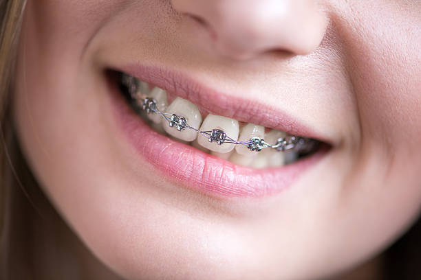 Advanced Braces Treatments for Misaligned Teeth