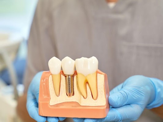 Dental Implants
