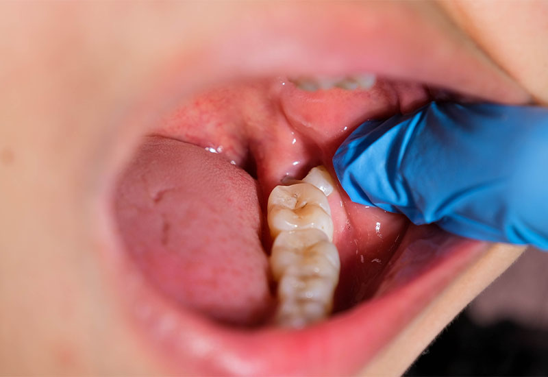 Wisdom Tooth Removal