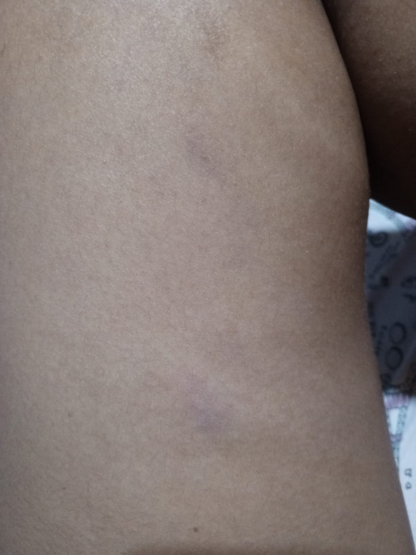 left thigh same spot with p2