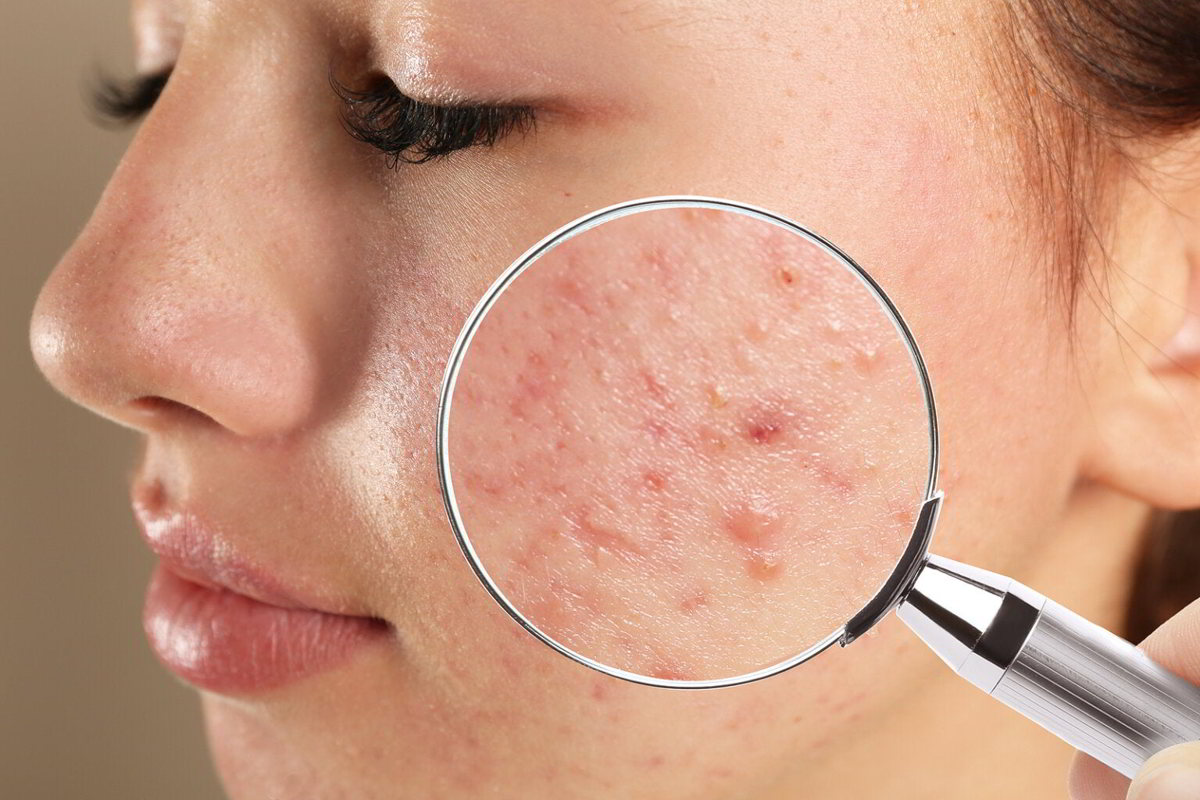 Semplice Rimedio Casalingo per sbarazzarsi dell’ACNE in modo naturale