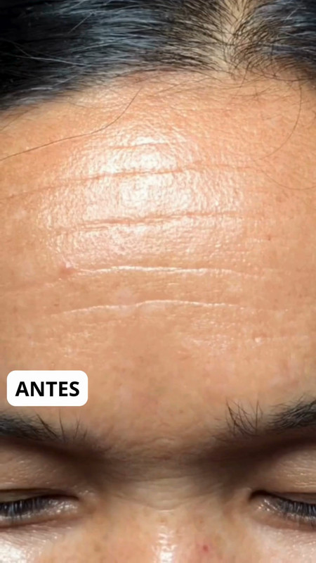 Pele envelhecida sem tratamento