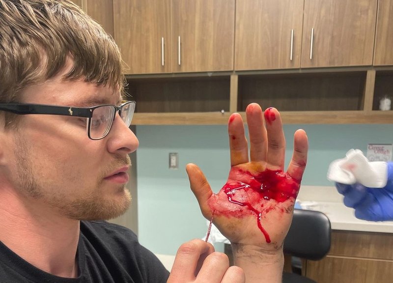 Брайс Мичъл се контузи със 7-сантиметрова треска