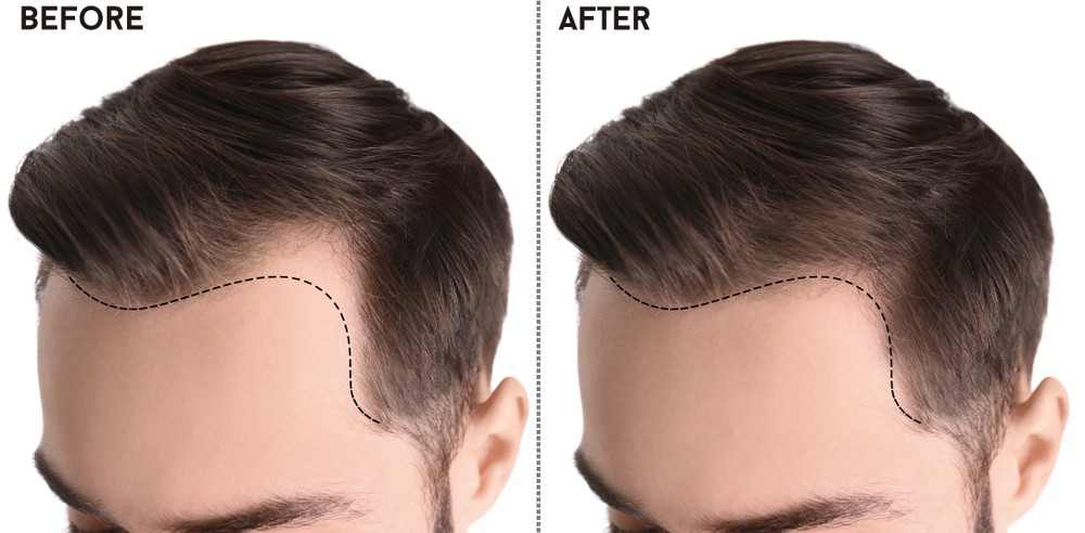 hair transplant in Dubai