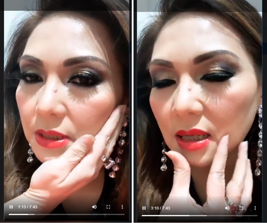 Nia Daniaty melalu siaran langsung instagram menjelaskan kondisi rahangnya pascakecelakaan