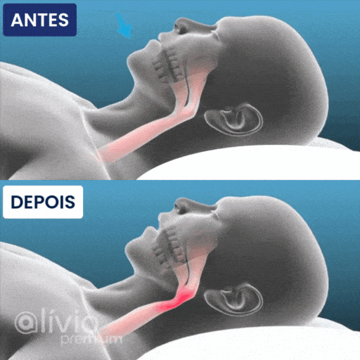 Protetor-Bucal-Anti-Ronco-Airsilent-Alivio-Premium-(1)