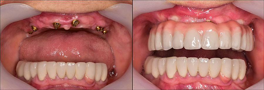 Multiple Teeth Replacement