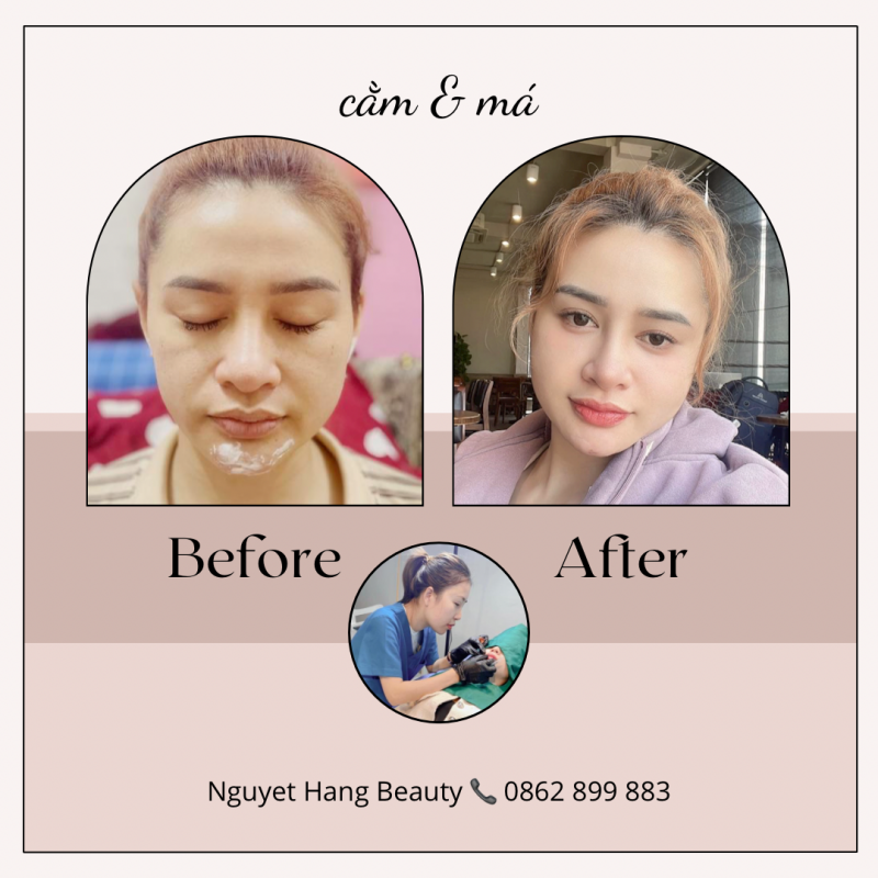 tiêm filler cằm và má ở Thanh Trì