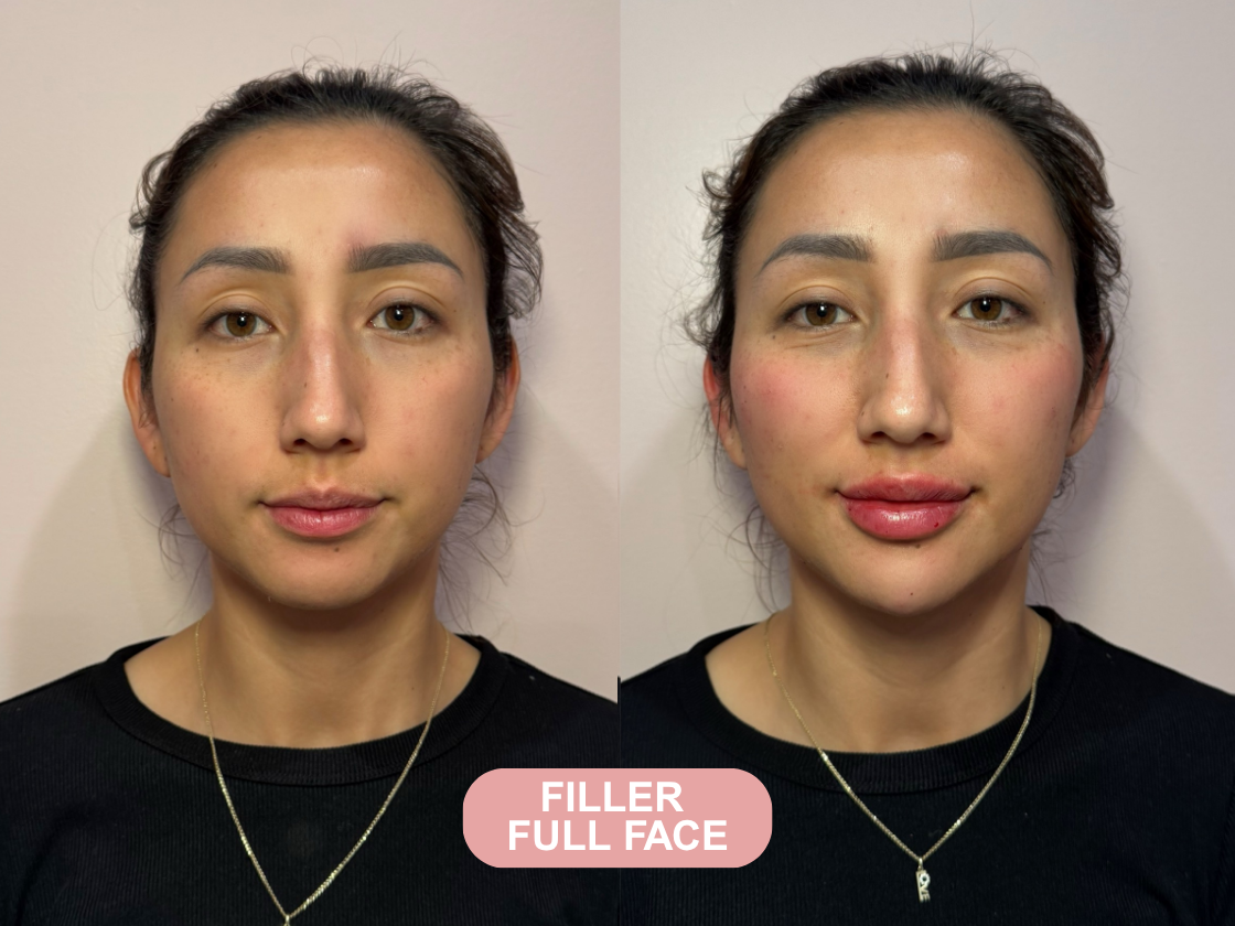 Chemical peel before and after results at Let's Face It Med Spa