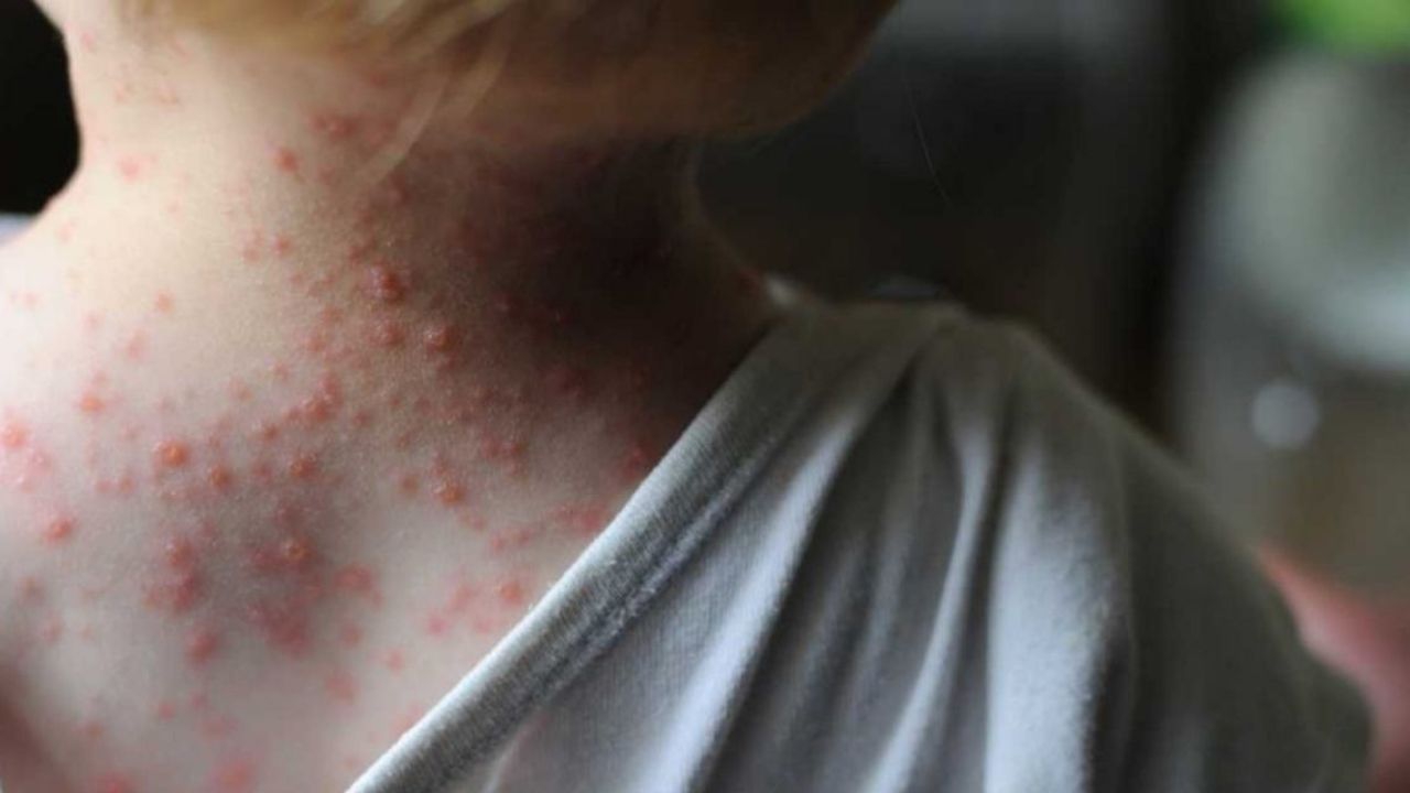 ¿Bill Gates advirtió la viruela del mono hace cinco meses? Esto dijo