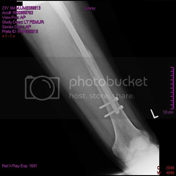 Surgeons who are CAREFUL about the length of their screws?