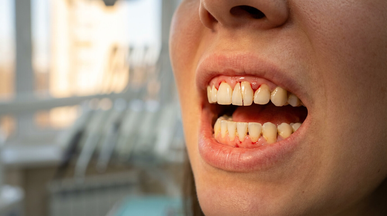 Признаки осложнений после установки винира