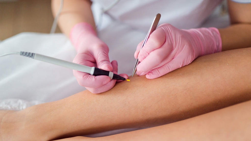 Электроэпиляция