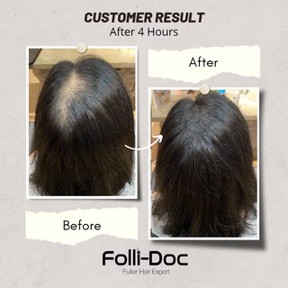 Before and after hair growth treatment for female hair thinning in Penang