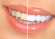 Teeth Whitening (In-office & At-home)