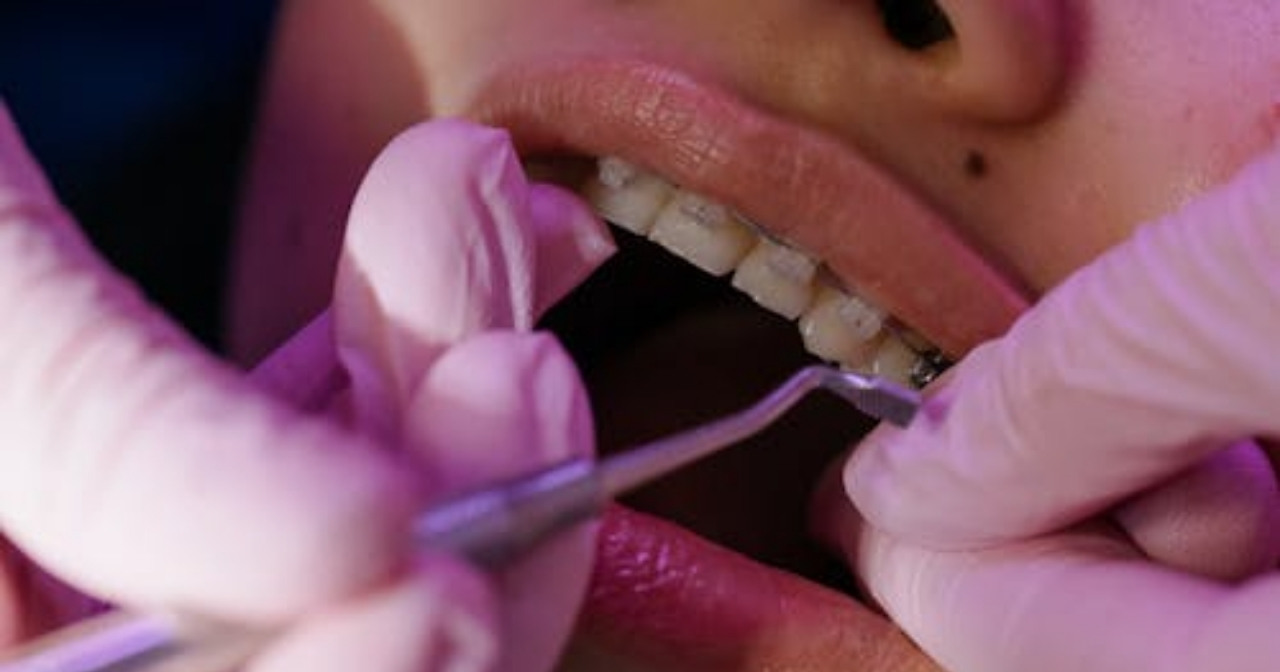 Don't Ignore Bleeding Gums: A Mumbaikar's Guide to Gum Disease Treatment