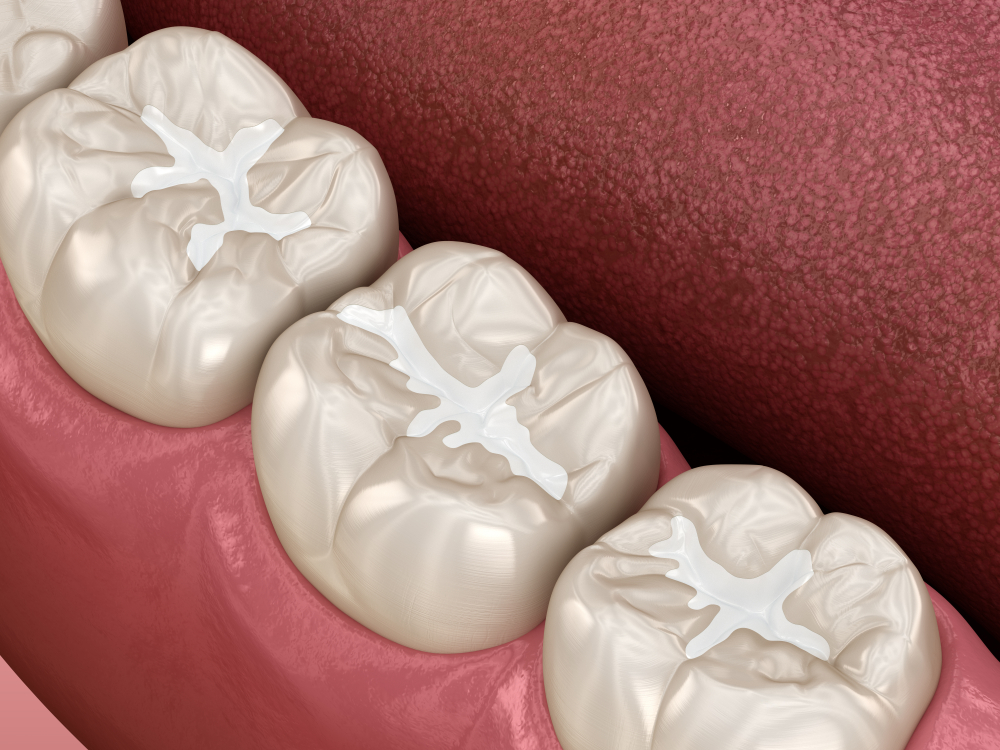 Preventive Sealants