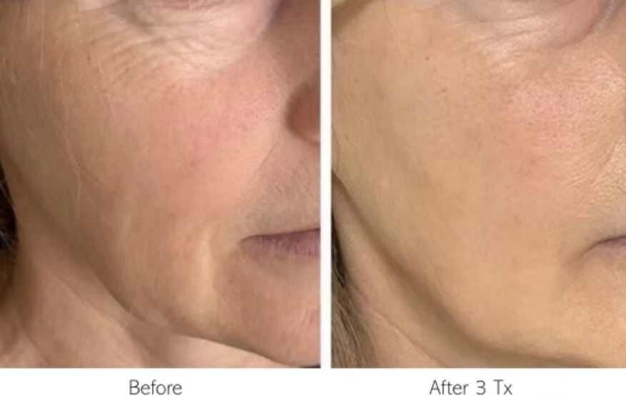 ClearLift before and after result at Let's Face It Med Spa in Denver.