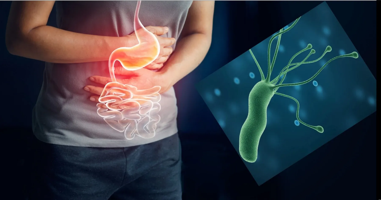 ¿Te duele el estómago? Puede ser por la bacteria Helicobacter pylori