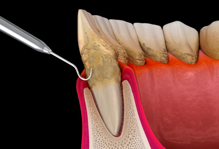 Pathological Mechanisms and the Efficacy of Teeth Scaling