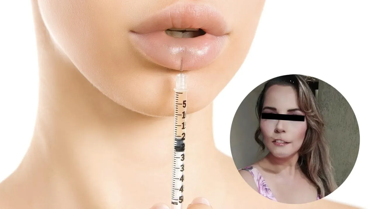 Influencer pierde los labios por culpa de procedimiento estético, así luce ahora