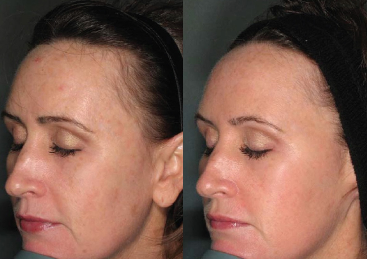 Before and after IPL treatment for pigmented lesions at Let's Face It Med Spa in Denver.