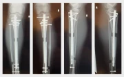 TIBIAS & FEMURS with Dr. Becker & Dr. Betz β FULL JOURNEY (8+5=13 CM)