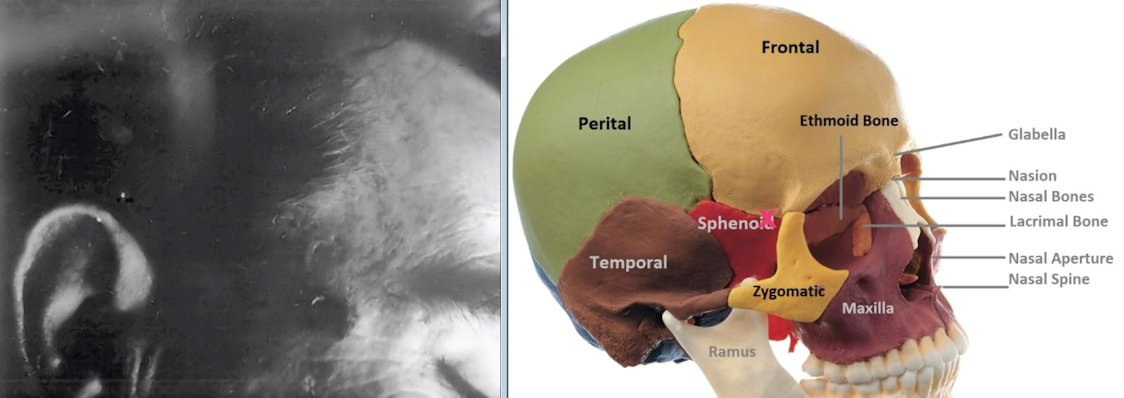 tippit-head-wound-compare.jpg