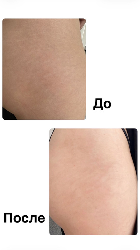 До и после процедуры 2