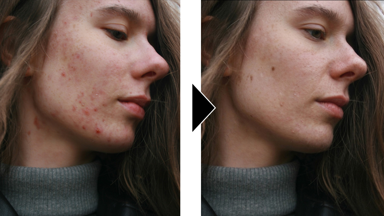 Result of: SKIN RETOUCH AND REMOVAL OF SPOTS