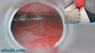 Insemination mit Samen im Gebärmutterhals, während Endoskop in der Gebärmutter