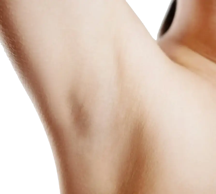 Best Laser Hair Removal In Bangladesh 3 After Best Laser Hair Removal Dhaka At Vita Skin