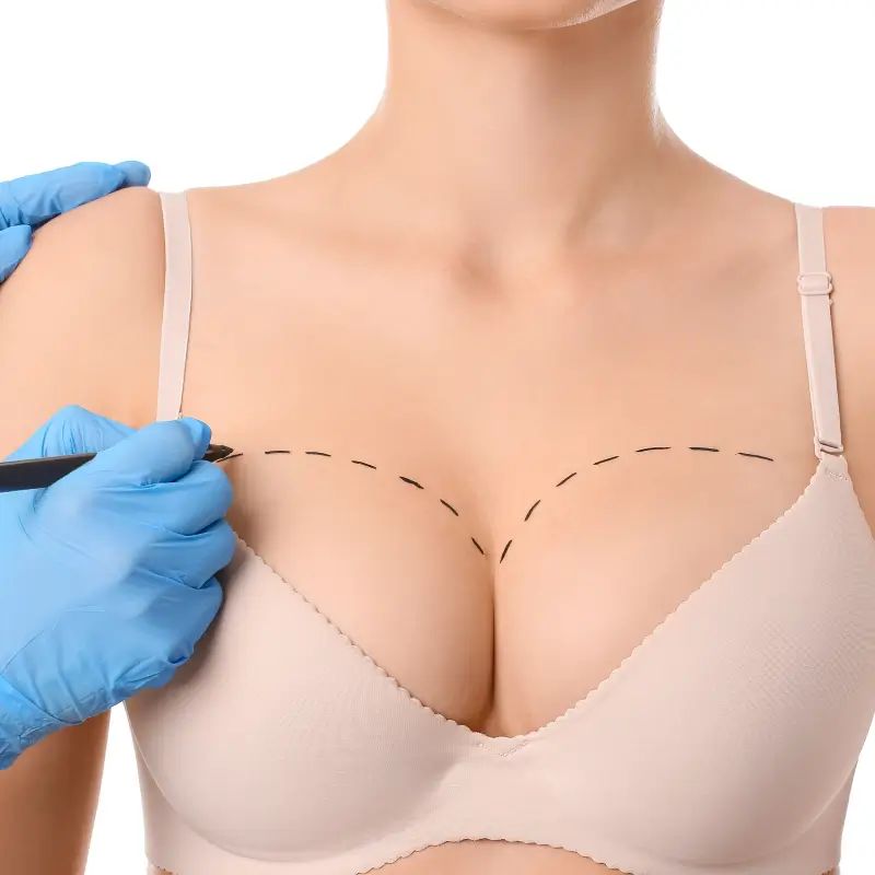 Mastopexy