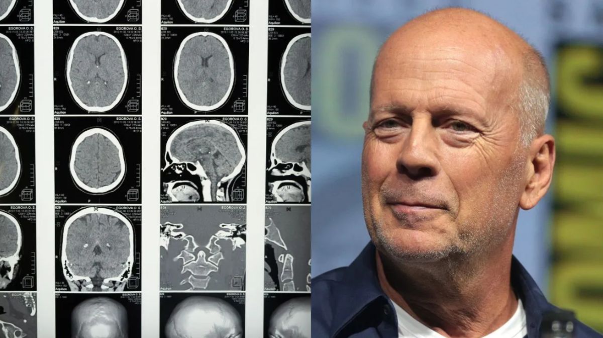 bruce willis demenza frontotemporale malattia crudele